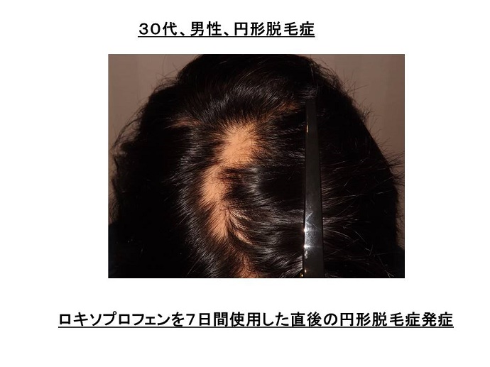 円形脱毛症　病院""